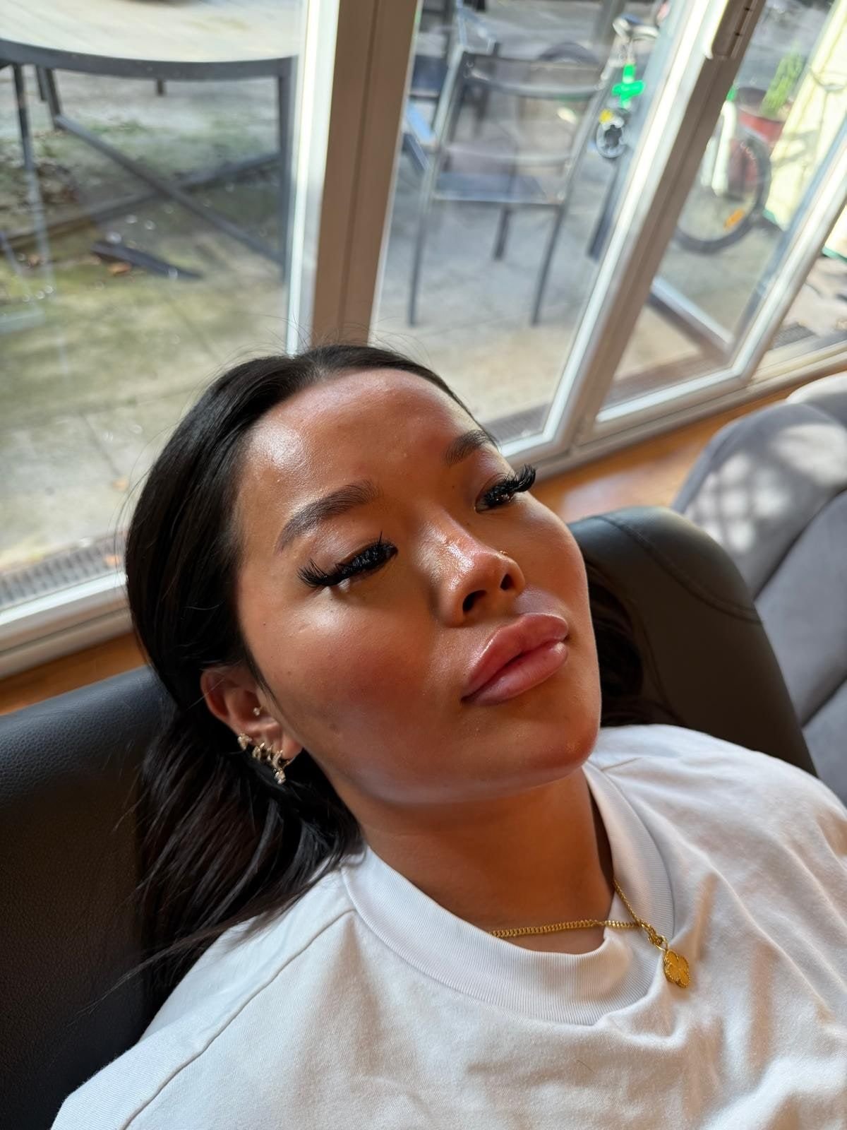 Lips after Russian lip filler